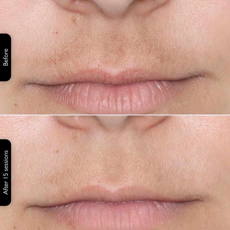 Rechargeable LED Photon Mask - Spa-Quality Glow at Home