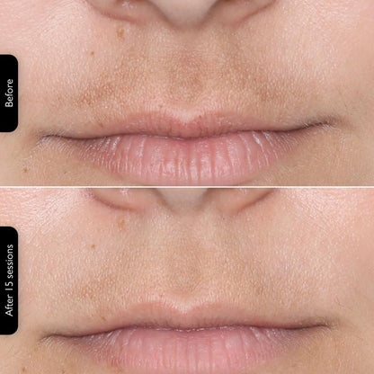 Rechargeable LED Photon Mask - Spa-Quality Glow at Home