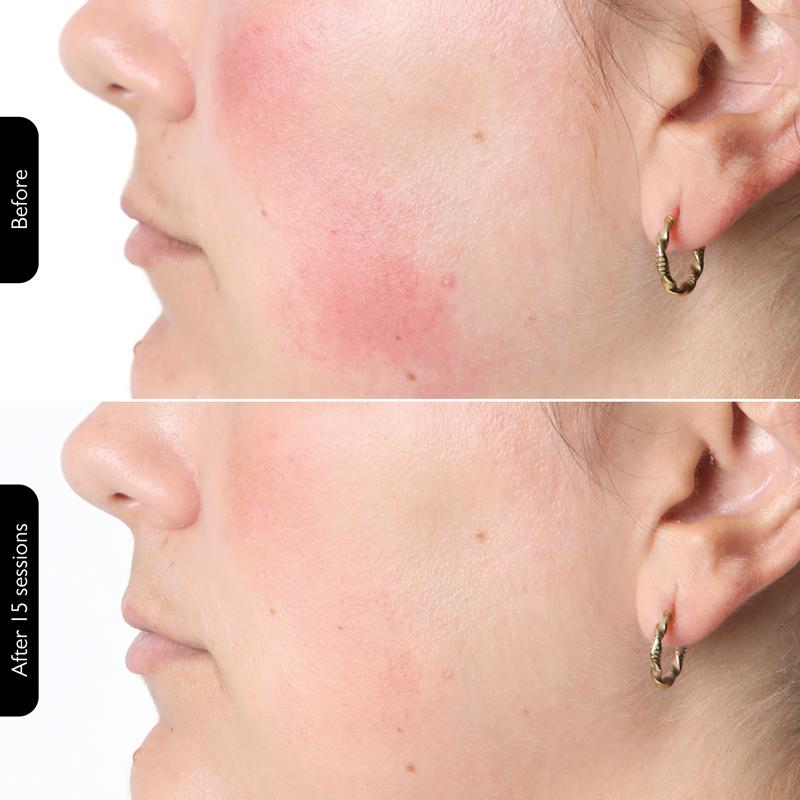 Rechargeable LED Photon Mask - Spa-Quality Glow at Home