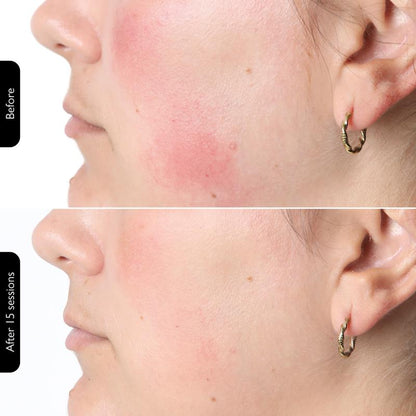 Rechargeable LED Photon Mask - Spa-Quality Glow at Home